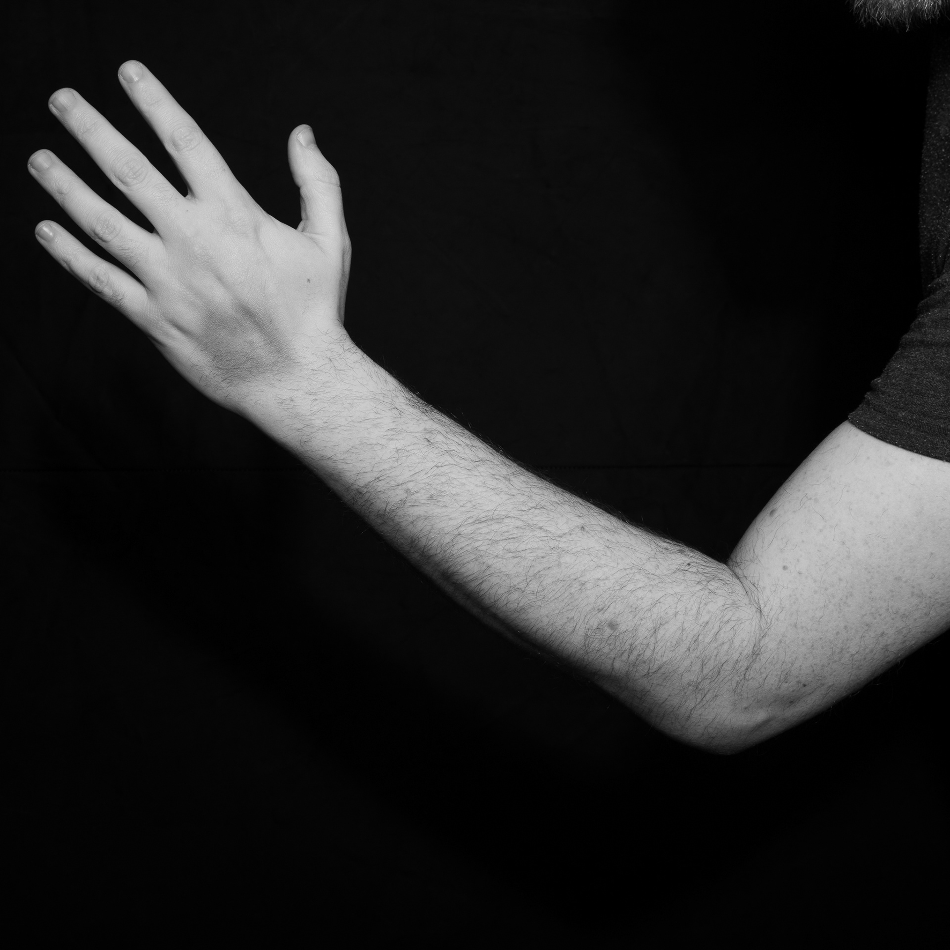 DVT: Bruised hand
