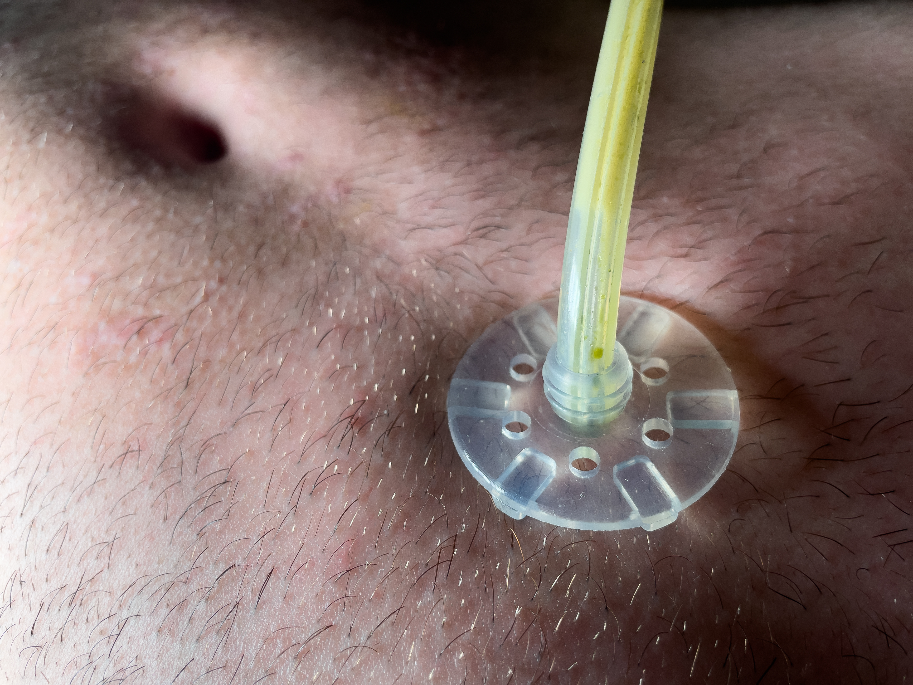 Feeling like The Bionic Man.