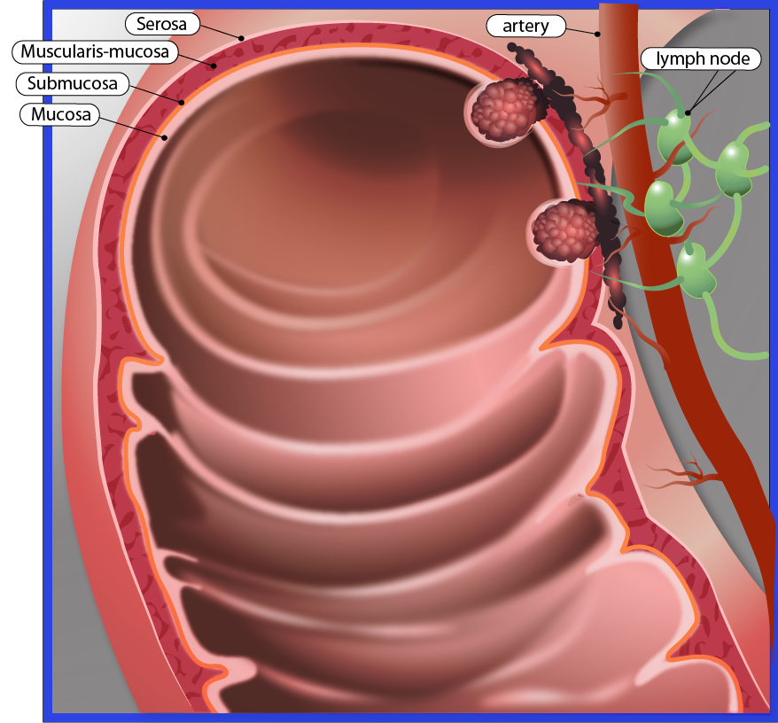 Development of duodenal carcinoma