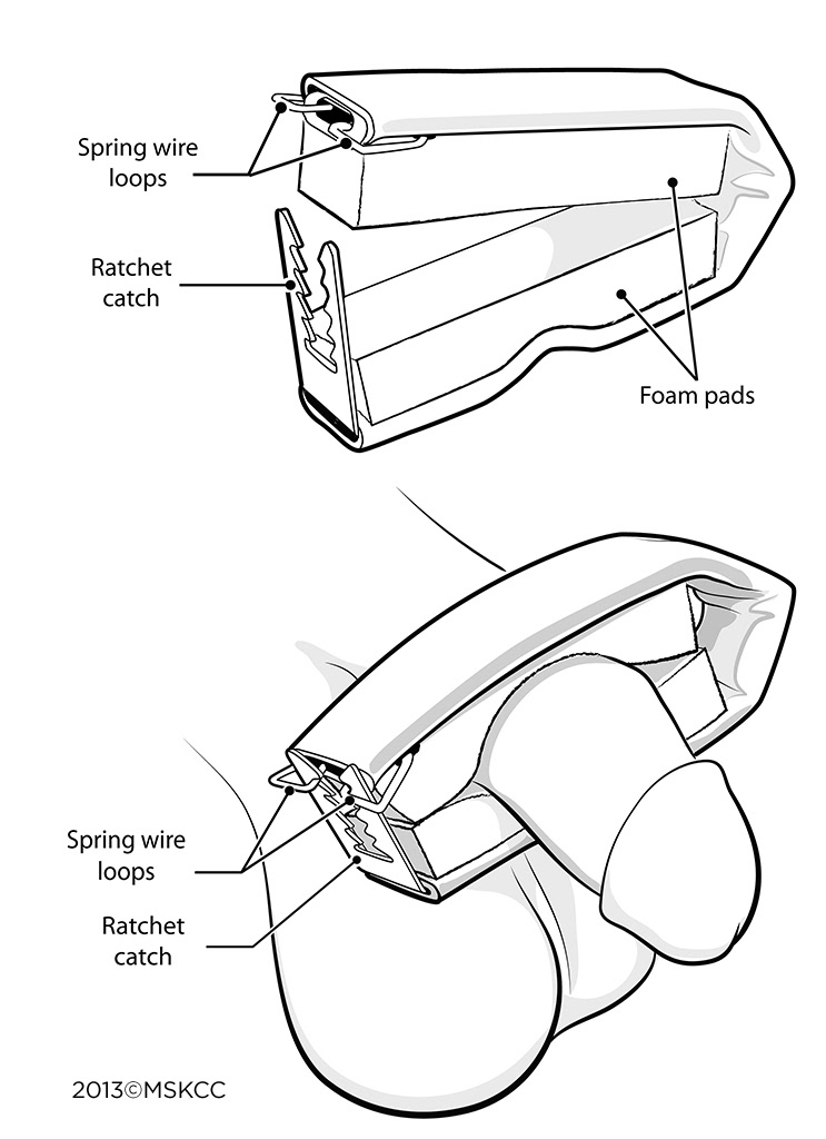 cunningham clamp patient education