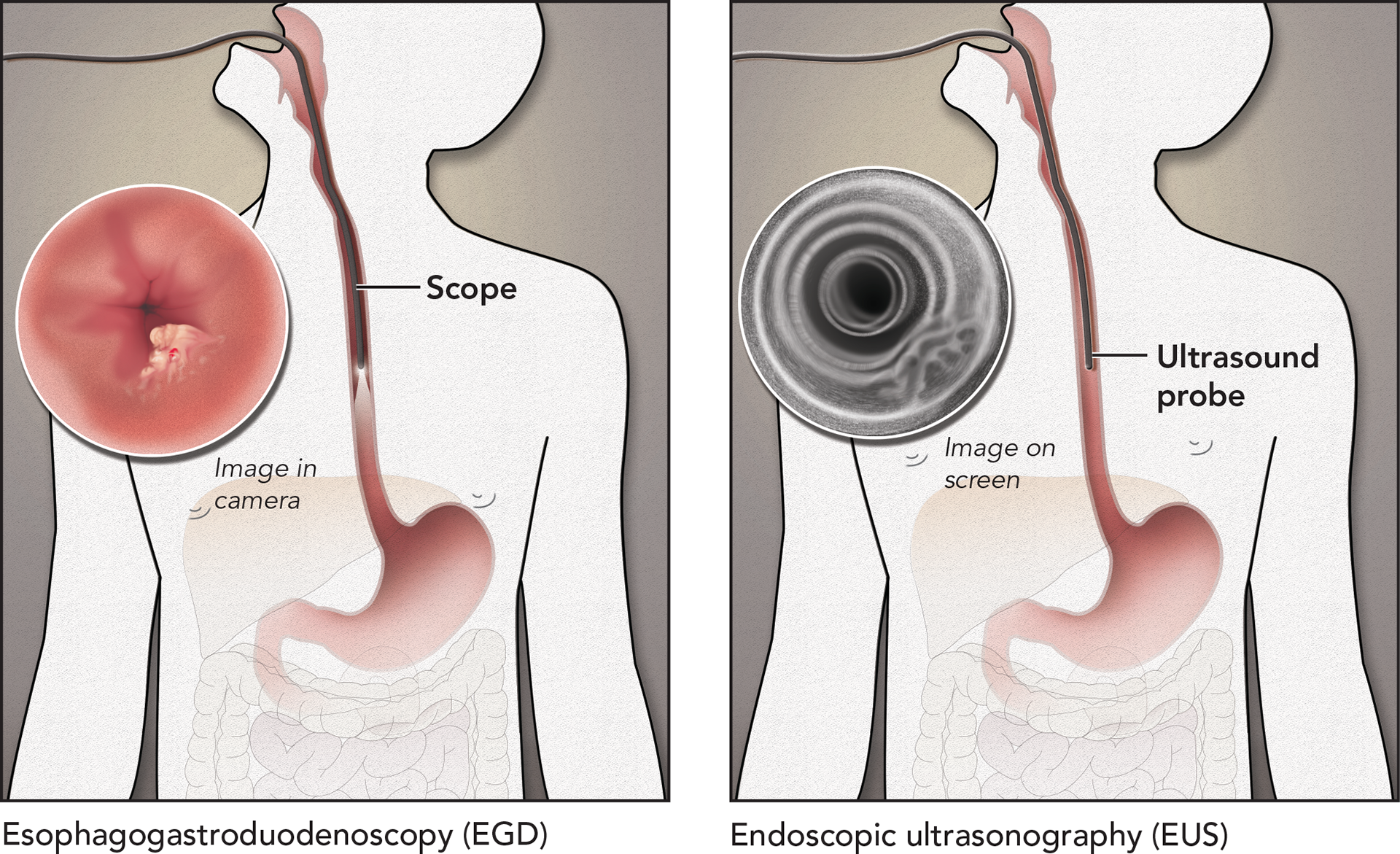 Evelyn Pence Esophagectomy